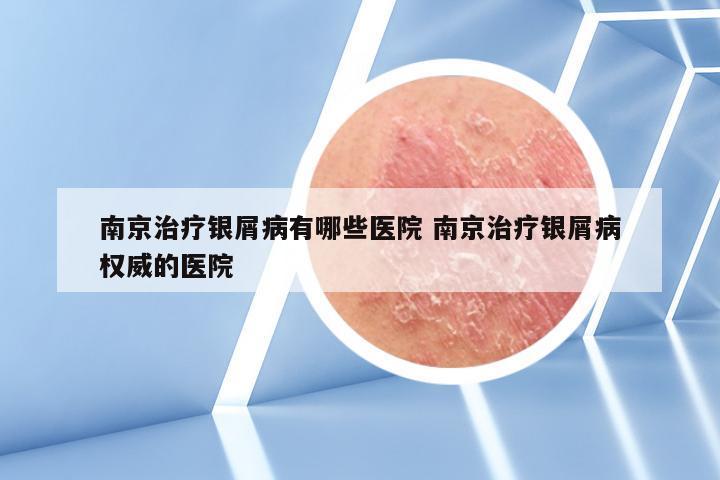 南京治疗银屑病有哪些医院 南京治疗银屑病权威的医院