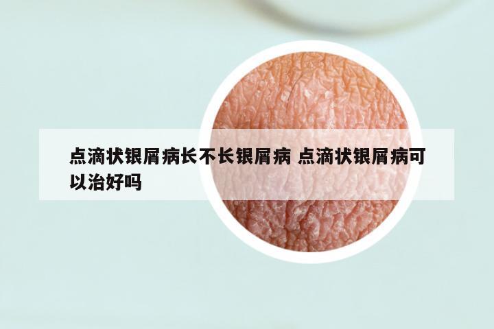 点滴状银屑病长不长银屑病 点滴状银屑病可以治好吗