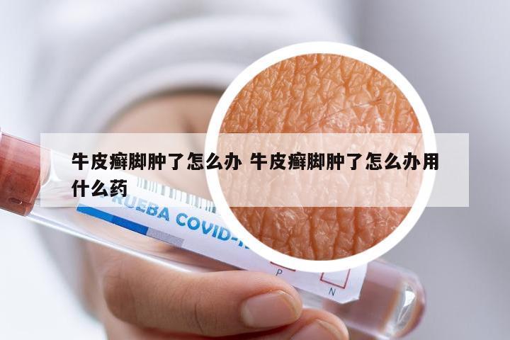 牛皮癣脚肿了怎么办 牛皮癣脚肿了怎么办用什么药