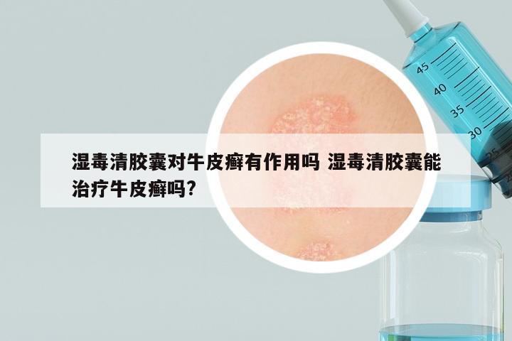 湿毒清胶囊对牛皮癣有作用吗 湿毒清胶囊能治疗牛皮癣吗?