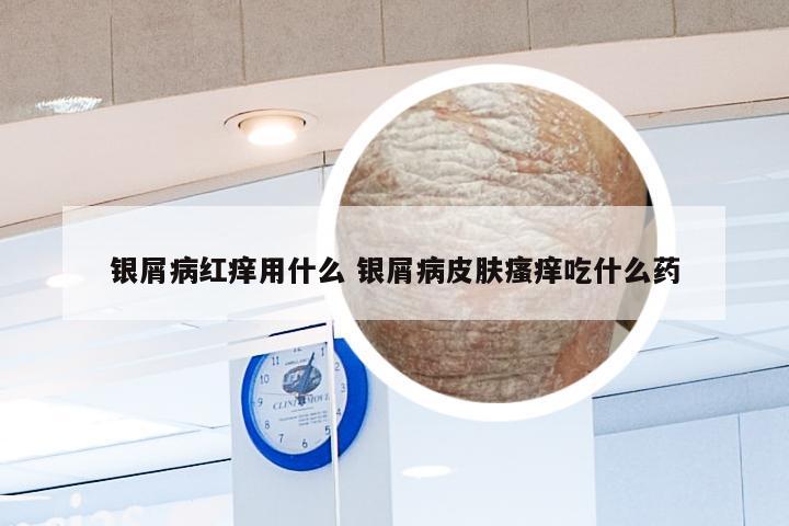 银屑病红痒用什么 银屑病皮肤瘙痒吃什么药
