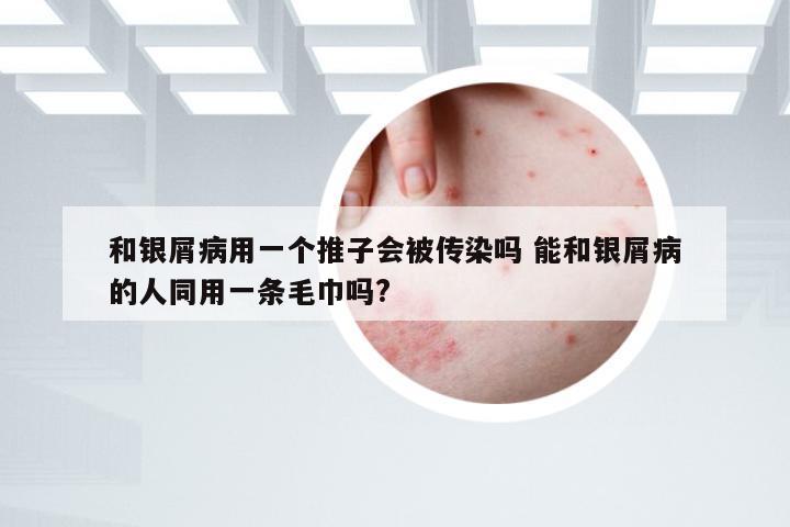 和银屑病用一个推子会被传染吗 能和银屑病的人同用一条毛巾吗?