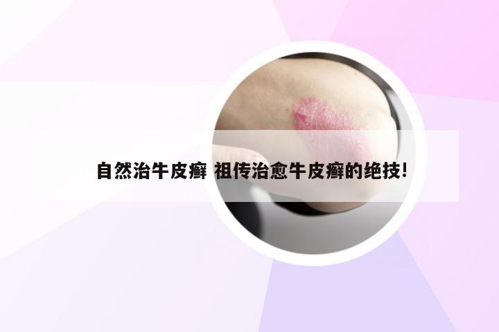 自然治牛皮癣 祖传治愈牛皮癣的绝技!