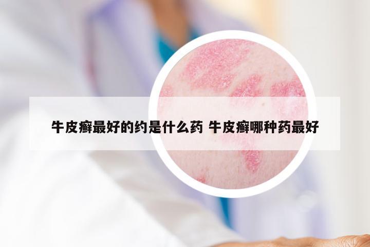 牛皮癣最好的约是什么药 牛皮癣哪种药最好