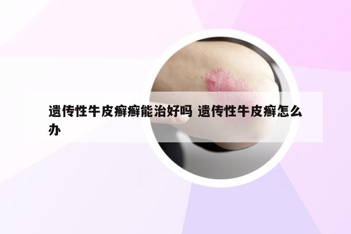 遗传性牛皮癣癣能治好吗 遗传性牛皮癣怎么办