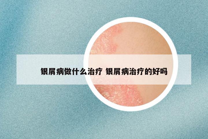 银屑病做什么治疗 银屑病治疗的好吗