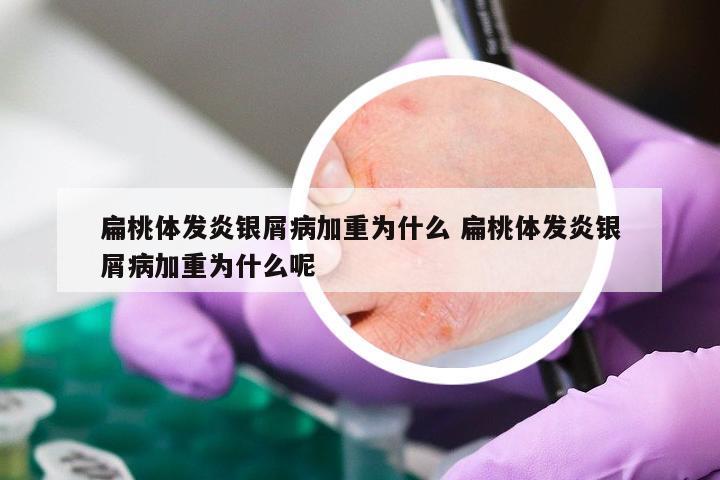 扁桃体发炎银屑病加重为什么 扁桃体发炎银屑病加重为什么呢