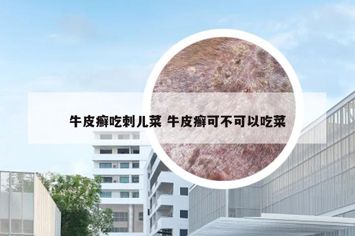 牛皮癣吃刺儿菜 牛皮癣可不可以吃菜