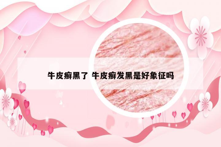 牛皮癣黑了 牛皮癣发黑是好象征吗