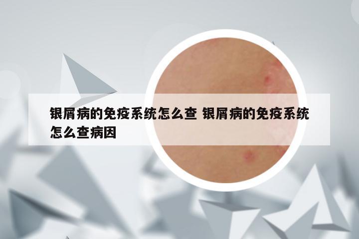 银屑病的免疫系统怎么查 银屑病的免疫系统怎么查病因