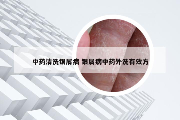 中药清洗银屑病 银屑病中药外洗有效方
