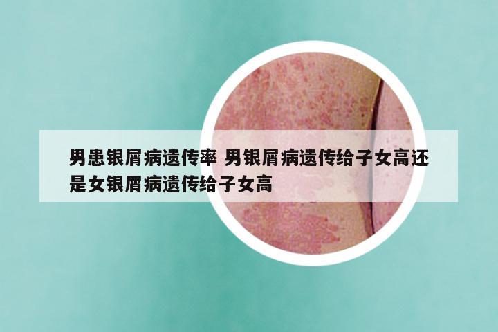 男患银屑病遗传率 男银屑病遗传给子女高还是女银屑病遗传给子女高