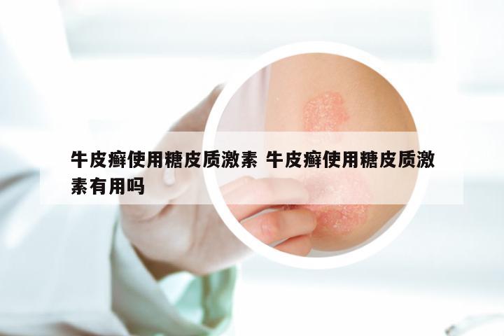 牛皮癣使用糖皮质激素 牛皮癣使用糖皮质激素有用吗