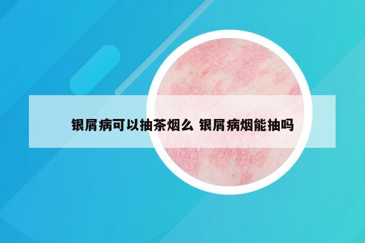 银屑病可以抽茶烟么 银屑病烟能抽吗