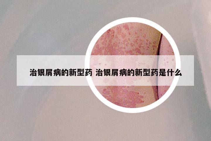 治银屑病的新型药 治银屑病的新型药是什么