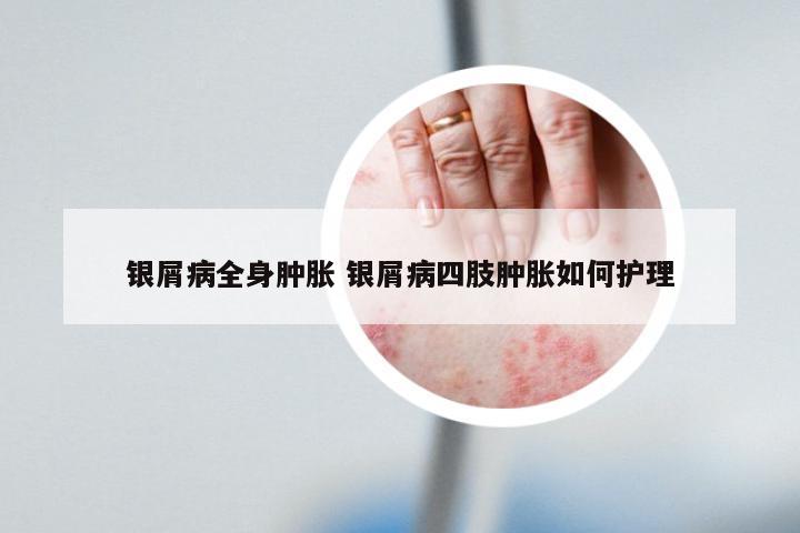 银屑病全身肿胀 银屑病四肢肿胀如何护理