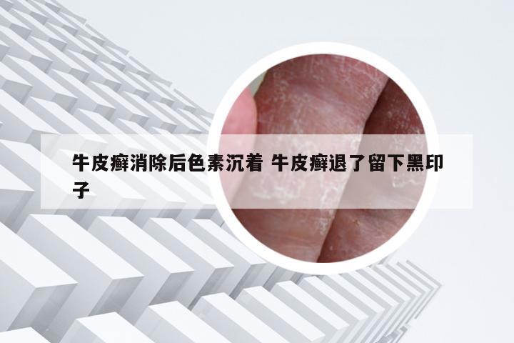 牛皮癣消除后色素沉着 牛皮癣退了留下黑印子