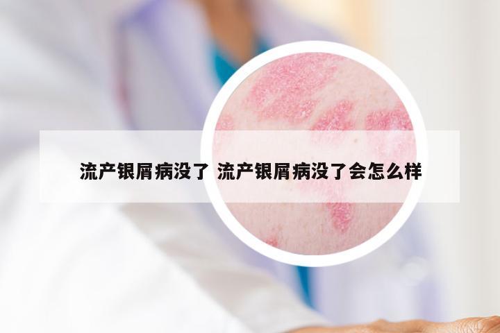 流产银屑病没了 流产银屑病没了会怎么样