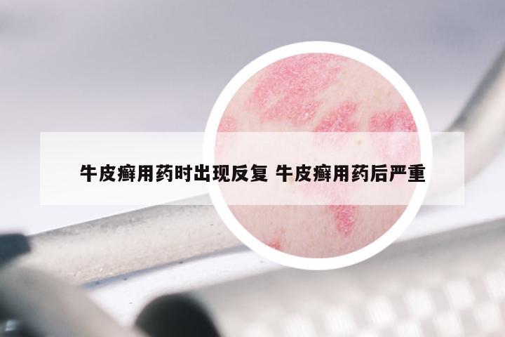 牛皮癣用药时出现反复 牛皮癣用药后严重