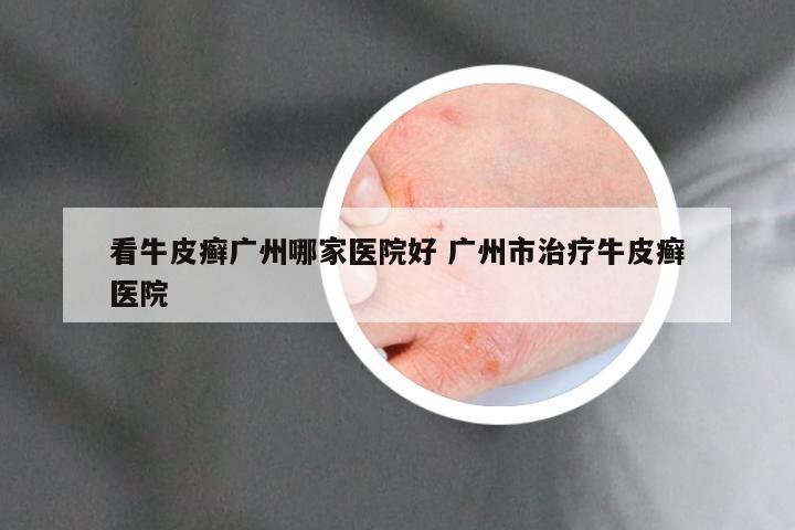 看牛皮癣广州哪家医院好 广州市治疗牛皮癣医院