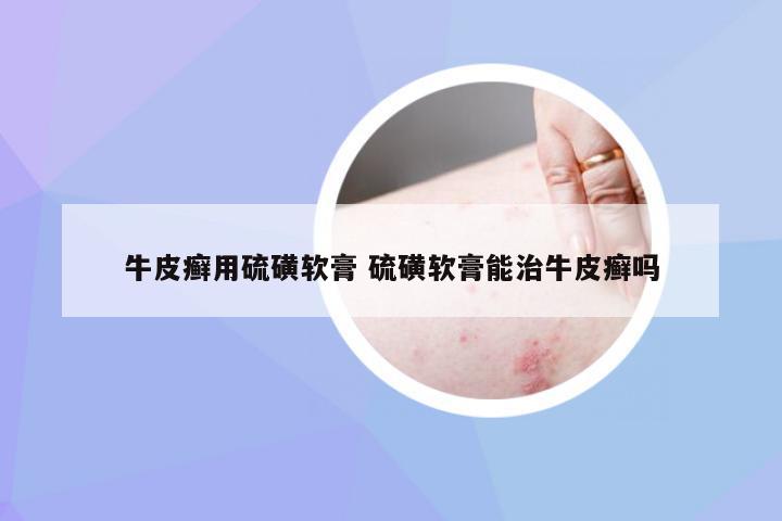 牛皮癣用硫磺软膏 硫磺软膏能治牛皮癣吗