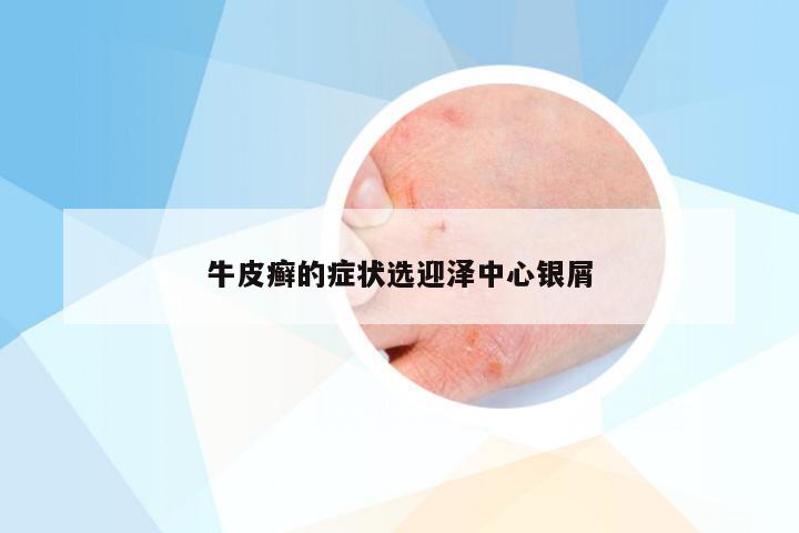 牛皮癣的症状选迎泽中心银屑