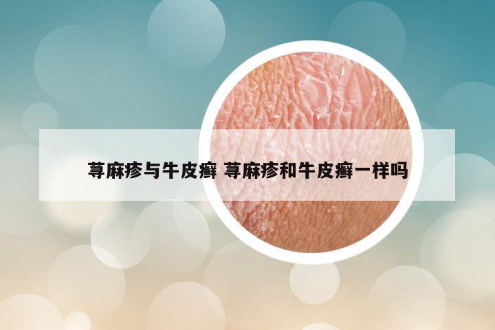 荨麻疹与牛皮癣 荨麻疹和牛皮癣一样吗