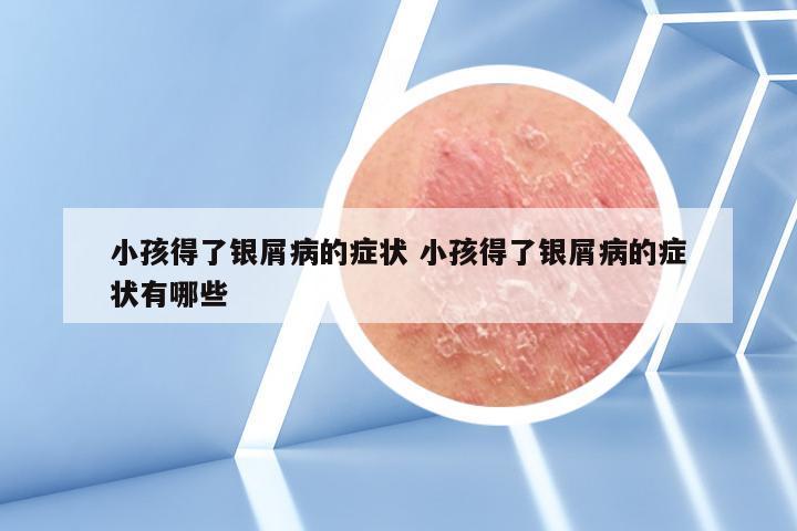 小孩得了银屑病的症状 小孩得了银屑病的症状有哪些