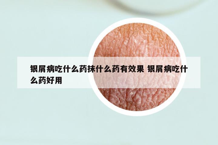 银屑病吃什么药抹什么药有效果 银屑病吃什么药好用