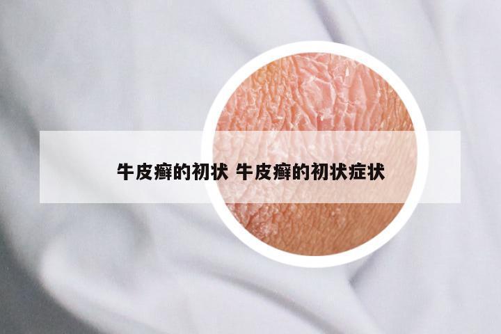 牛皮癣的初状 牛皮癣的初状症状