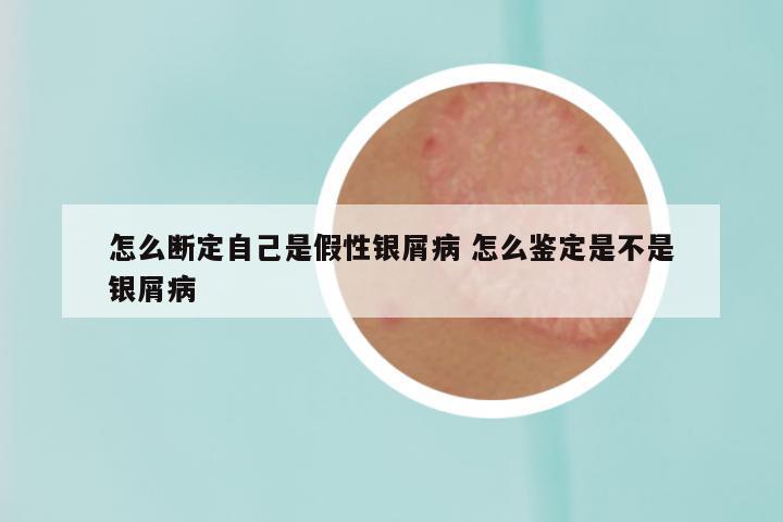 怎么断定自己是假性银屑病 怎么鉴定是不是银屑病