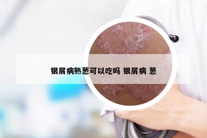 银屑病熟葱可以吃吗 银屑病 葱