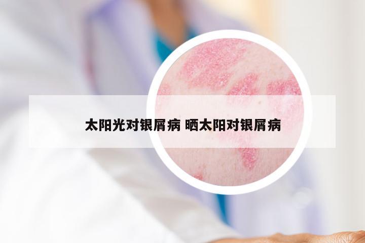 太阳光对银屑病 晒太阳对银屑病