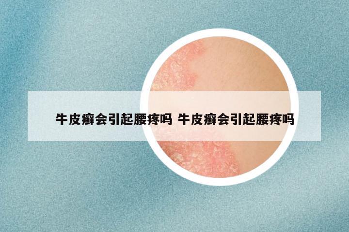 牛皮癣会引起腰疼吗 牛皮癣会引起腰疼吗