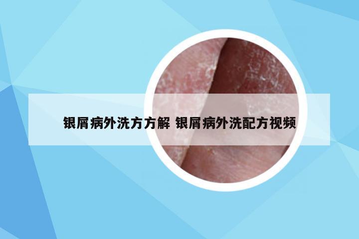 银屑病外洗方方解 银屑病外洗配方视频