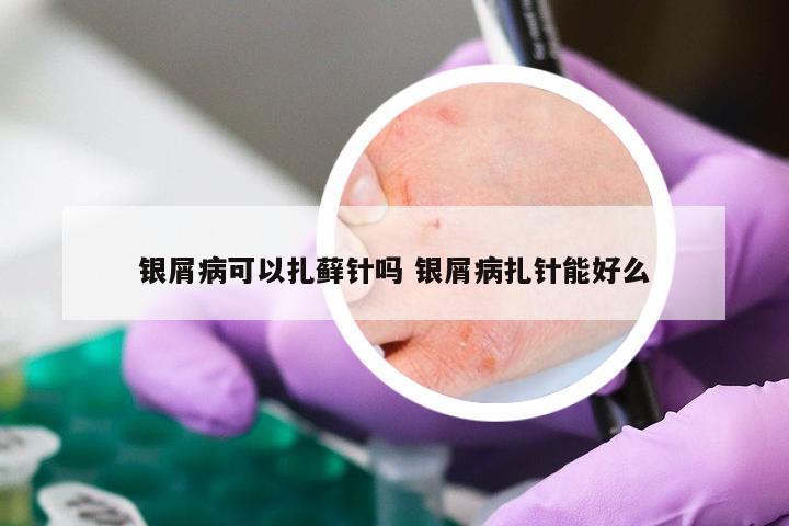 银屑病可以扎藓针吗 银屑病扎针能好么