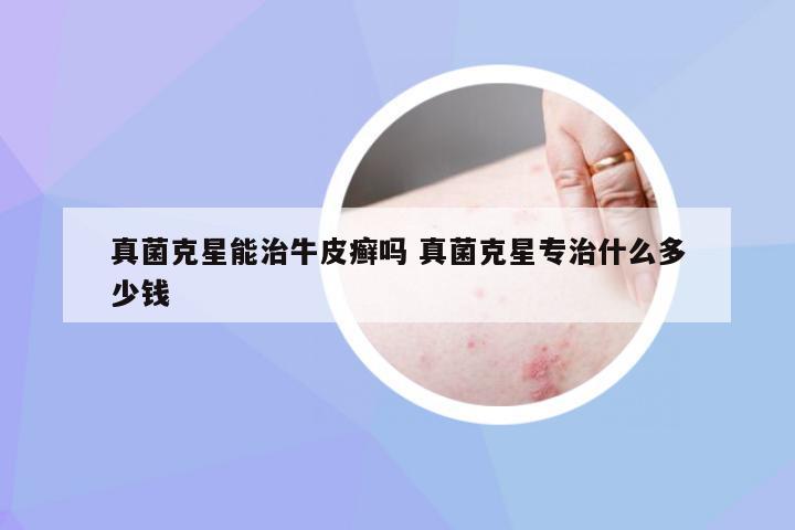 真菌克星能治牛皮癣吗 真菌克星专治什么多少钱