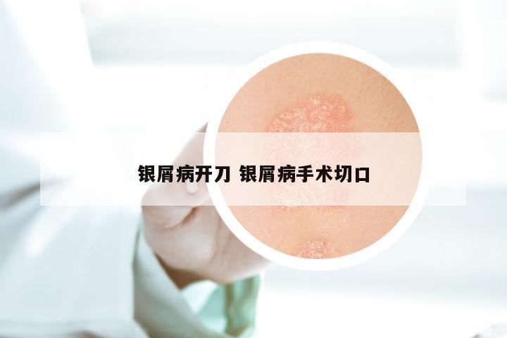 银屑病开刀 银屑病手术切口