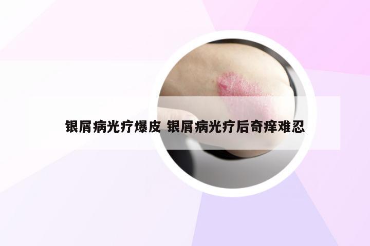银屑病光疗爆皮 银屑病光疗后奇痒难忍