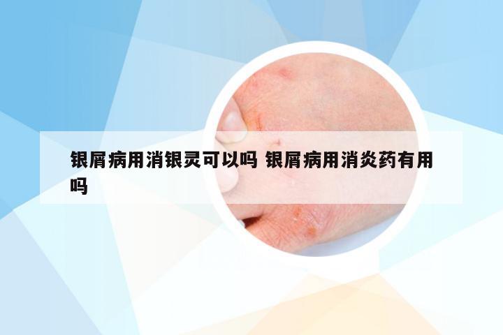 银屑病用消银灵可以吗 银屑病用消炎药有用吗