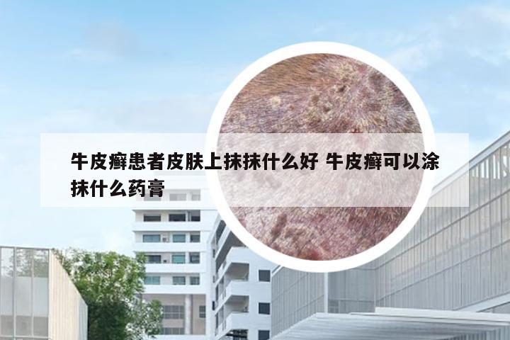 牛皮癣患者皮肤上抹抹什么好 牛皮癣可以涂抹什么药膏