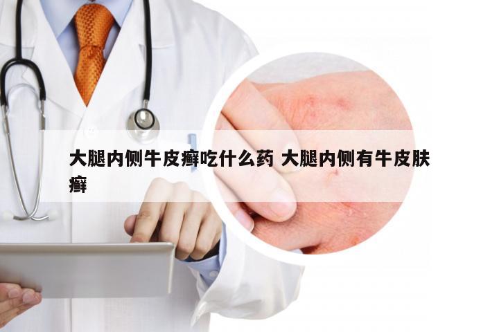 大腿内侧牛皮癣吃什么药 大腿内侧有牛皮肤癣