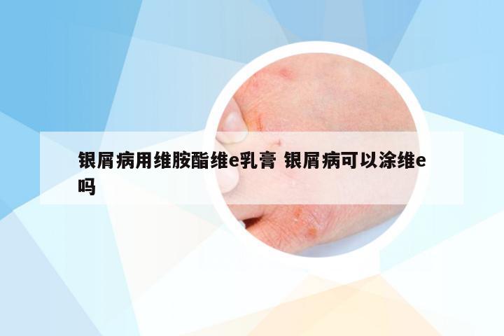 银屑病用维胺酯维e乳膏 银屑病可以涂维e吗