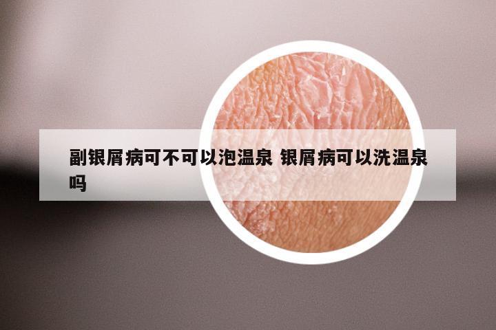 副银屑病可不可以泡温泉 银屑病可以洗温泉吗