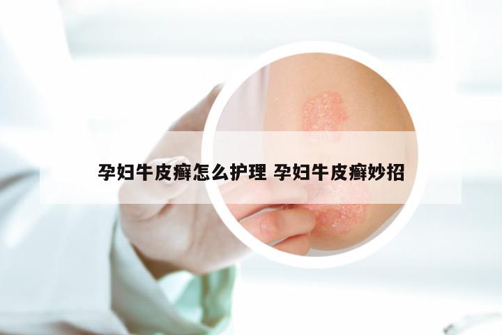 孕妇牛皮癣怎么护理 孕妇牛皮癣妙招