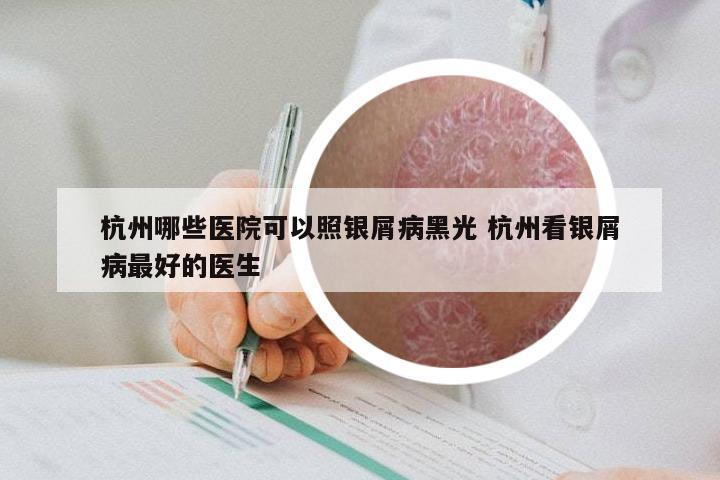 杭州哪些医院可以照银屑病黑光 杭州看银屑病最好的医生