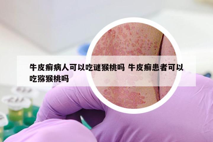 牛皮癣病人可以吃谜猴桃吗 牛皮癣患者可以吃猕猴桃吗