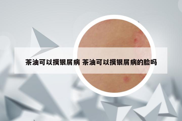 茶油可以摸银屑病 茶油可以摸银屑病的脸吗