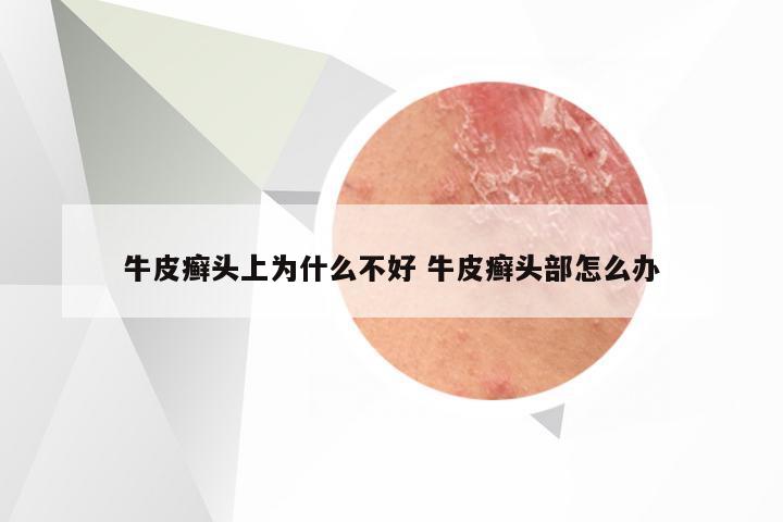 牛皮癣头上为什么不好 牛皮癣头部怎么办