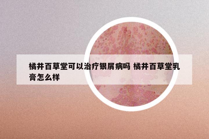 橘井百草堂可以治疗银屑病吗 橘井百草堂乳膏怎么样